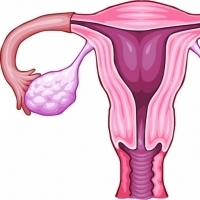 HPV – Rakovina krčka maternice
